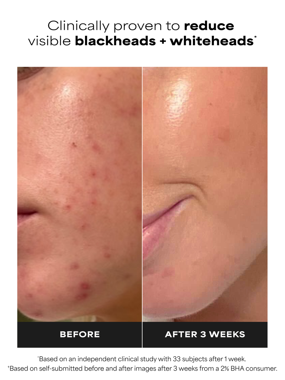 2% BHA Liquid Exfoliant (Exfoliante Líquido)